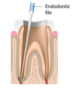 Endodontic file