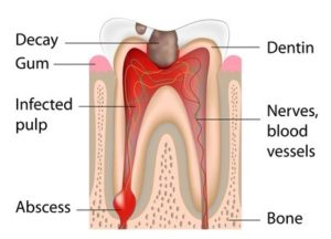 Root Canal therapy