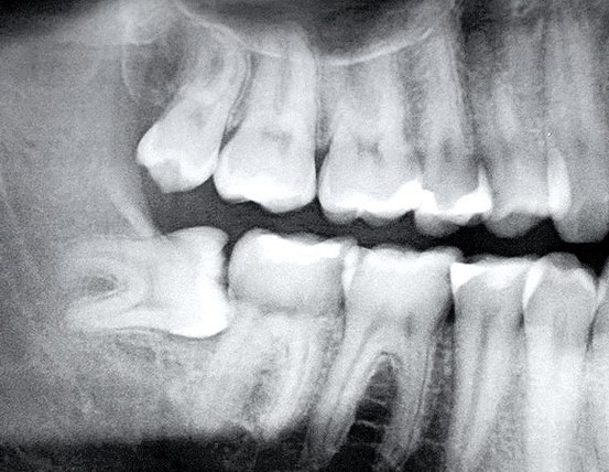 Wisdom Teeth Mosman Village Dentistry